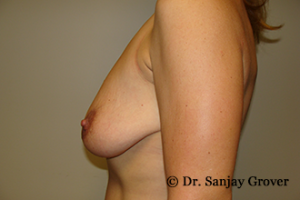 Breast Lift Before and After 39 | Sanjay Grover MD FACS