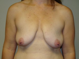 Breast Lift Before and After 20 | Grover Aesthetics
