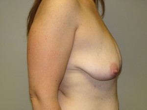 Breast Lift Before and After 40 | Sanjay Grover MD FACS