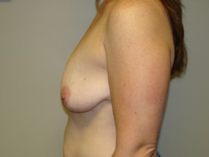 Breast Lift Before and After 40 | Grover Aesthetics
