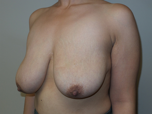 Breast Lift Before and After 41 | Sanjay Grover MD FACS