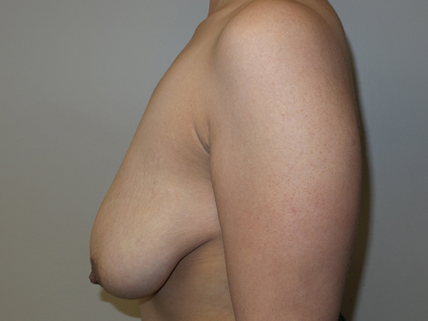 Breast Lift Before and After 41 | Grover Aesthetics