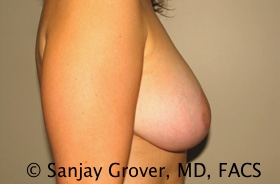 Breast Lift Before and After 44 | Grover Aesthetics