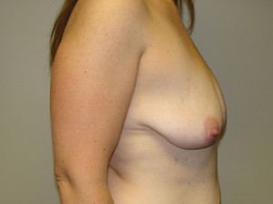 Breast Lift Before and After 45 | Grover Aesthetics