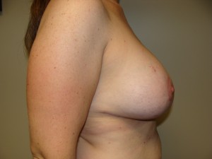 Breast Lift Before and After 45 | Grover Aesthetics