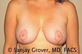 Breast Lift Before and After | Grover Aesthetics