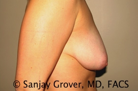 Breast Lift Before and After 49 | Grover Aesthetics
