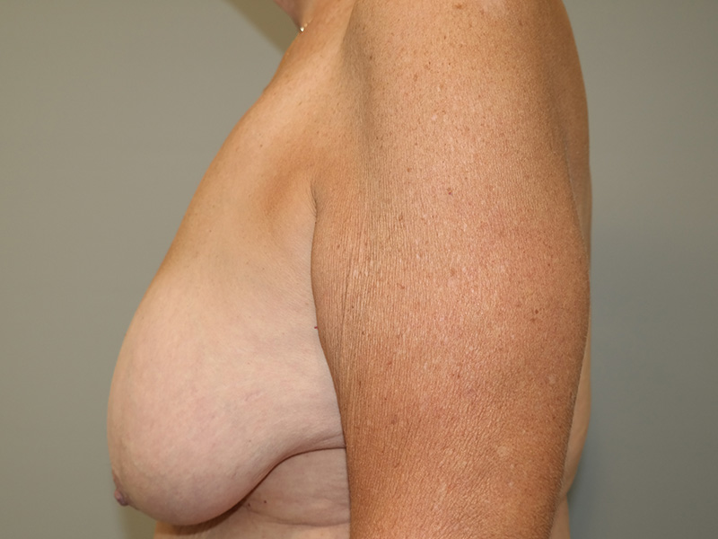 Breast Reduction Before and After 02 | Grover Aesthetics