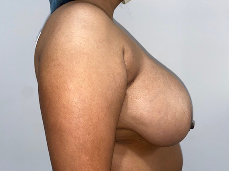 Breast Reduction Before and After 03 | Grover Aesthetics