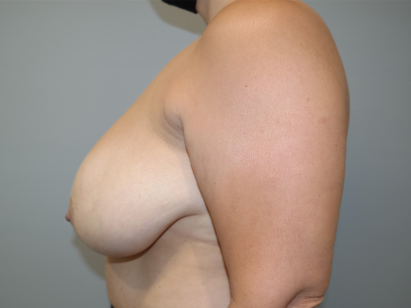 Breast Reduction Before and After 04 | Grover Aesthetics