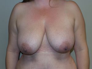 Breast Reduction Before and After 10 | Sanjay Grover MD FACS
