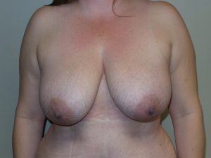 Breast Reduction Before and After | Grover Aesthetics