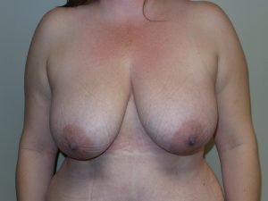 Breast Reduction Before and After 15 | Sanjay Grover MD FACS