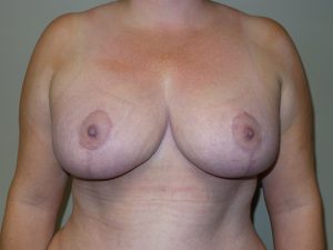 Breast Reduction Before and After | Grover Aesthetics