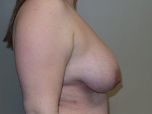 Breast Reduction Before and After 07 | Grover Aesthetics