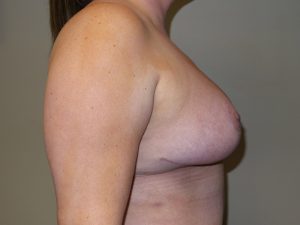 Breast Reduction Before and After 07 | Grover Aesthetics