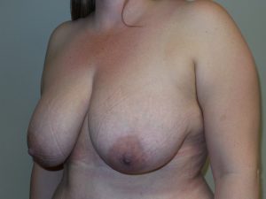Breast Reduction Before and After 07 | Sanjay Grover MD FACS