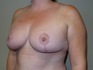 Breast Reduction Before and After 07 | Grover Aesthetics