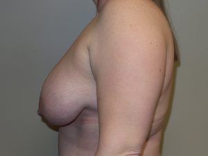 Breast Reduction Before and After 07 | Grover Aesthetics