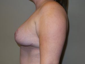 Breast Reduction Before and After 07 | Grover Aesthetics