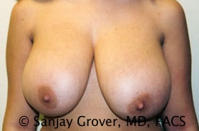 Breast Reduction Before and After 17 | Sanjay Grover MD FACS