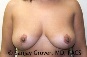 Breast Reduction Before and After 08 | Sanjay Grover MD FACS