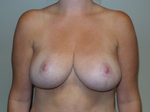 Breast Reduction Before and After | Grover Aesthetics