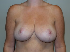 Breast Reduction Before and After | Sanjay Grover MD FACS