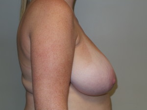 Breast Reduction Before and After 09 | Grover Aesthetics