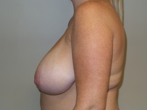 Breast Reduction Before and After 09 | Grover Aesthetics