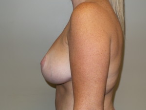 Breast Reduction Before and After 09 | Grover Aesthetics