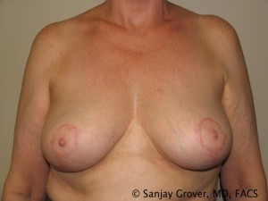 Breast Reduction Before and After | Grover Aesthetics