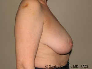 Breast Reduction Before and After 10 | Sanjay Grover MD FACS