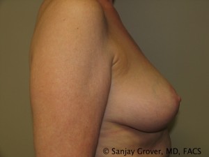 Breast Reduction Before and After 10 | Sanjay Grover MD FACS