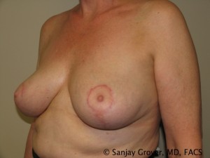 Breast Reduction Before and After 10 | Sanjay Grover MD FACS