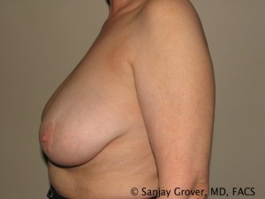 Breast Reduction Before and After 10 | Sanjay Grover MD FACS