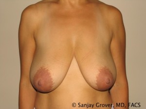 Breast Reduction Before and After | Grover Aesthetics