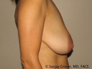 Breast Reduction Before and After 11 | Grover Aesthetics