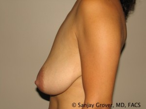 Breast Reduction Before and After 11 | Grover Aesthetics