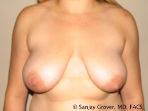 Breast Reduction Before and After 07 | Sanjay Grover MD FACS