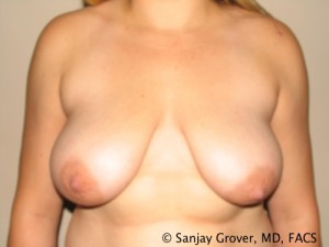 Breast Reduction Before and After | Grover Aesthetics
