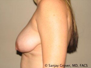 Breast Reduction Before and After 12 | Grover Aesthetics