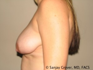 Breast Reduction Before and After 12 | Sanjay Grover MD FACS