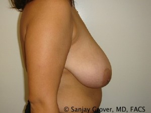 Breast Reduction Before and After 13 | Grover Aesthetics