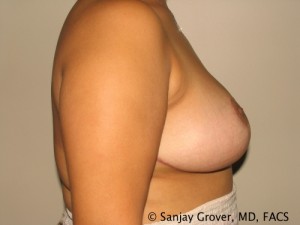Breast Reduction Before and After 13 | Grover Aesthetics
