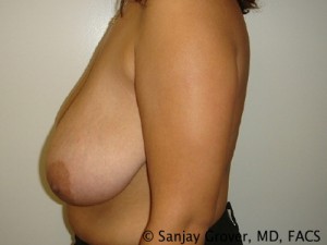 Breast Reduction Before and After 13 | Sanjay Grover MD FACS