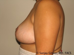 Breast Reduction Before and After 13 | Grover Aesthetics