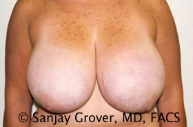 Breast Reduction Before and After 11 | Sanjay Grover MD FACS