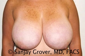 Breast Reduction Before and After | Sanjay Grover MD FACS