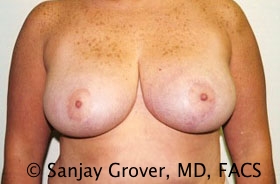 Breast Reduction Before and After | Grover Aesthetics
